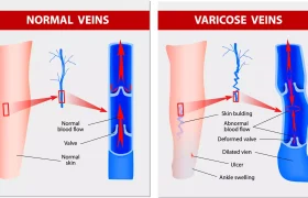 What are the harms of varicose veins?