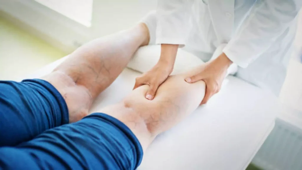 How is Varicose Vein Treatment Done?